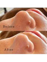 ブリリアントライフ(Blilyant life)/毛穴洗浄＋白玉酸素セラピー