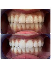 ホワイトベリー 空港通店(White Berry)/ホワイトニング：ビフォアフター