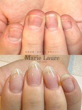 マリーロール 天王寺店(Marie Laure)/自爪育成/深爪矯正/ネイルケア