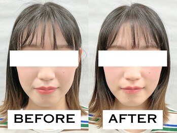 ビハリスト 恵比寿/ほうれい線の改善に自信アリ!