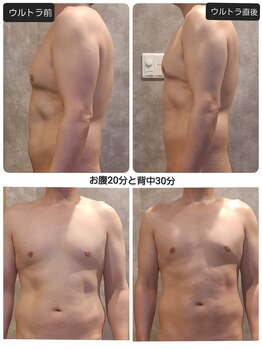 ヴィトワ(Vitowa)/ウルトランスフォーマー施術例3