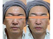 マザートウキョウ(Mother TOKYO)/ほうれい線改善できます！