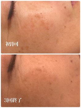 ディス イズ ミー エステティック(This is Me Aesthetic)/シミケアモニタープラン