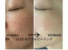 メディカルサロンドオフ 堺東店(medical salon de off)/LEZE(ルゼ)カクテルピーリング