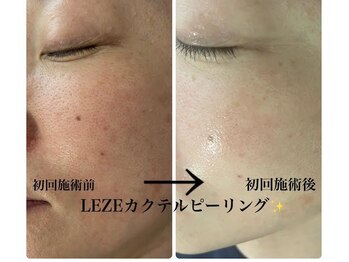 メディカルサロンドオフ 堺東店(medical salon de off)/LEZE(ルゼ)カクテルピーリング