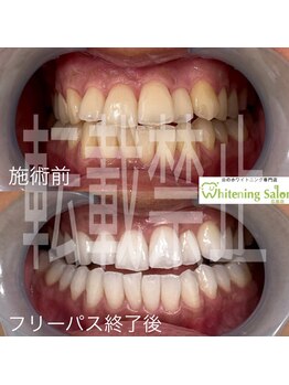 ホワイトニングサロン 広島店/【ホワイトニング施術例】