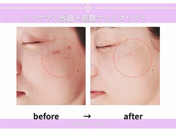 カピリナスパ(Ka.Pilina Spa)/シミケア6回目 before⇒after