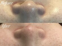 アンドナイン エス店(ANDNINE.)/毛穴洗浄