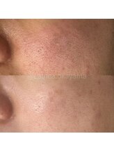 ラウレア(Laule'a)/津山｜毛穴ケア半年後