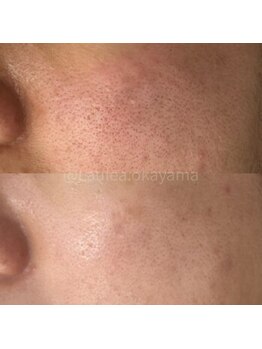 ラウレア(Laule'a)/津山|毛穴ケア半年後