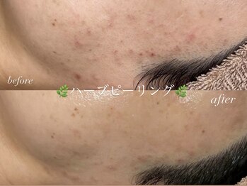 まつげエクステ専門店 クレイン(CRANE)/ハーブピーリング