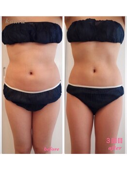 カウラ(Kaura)/中半身ビフォーアフター(肥後橋)