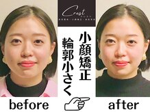 クレスト(CREST)/ビフォーアフター【小顔名古屋】