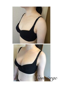 ラポッシュ(La poche)/バストアップ症例写真