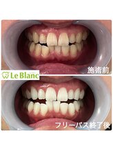 ルブラン 奈良店(Le Blanc)/歯の黄ばみ解決！