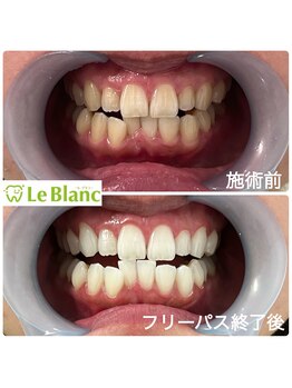 ルブラン 奈良店(Le Blanc)/歯の黄ばみ解決！