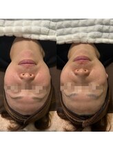 ミヨン(Miyong)/フェイスラインがシャープに♪