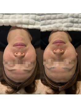 ミヨン(Miyong)/フェイスラインがシャープに♪