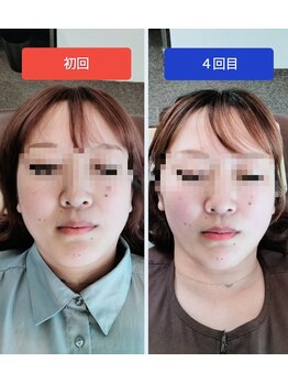 ユープラス(YOU PLUS)/美容鍼４回コース