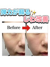 ミムー/before／after