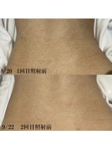 ソワン(Soin)/美肌イオン導入脱毛