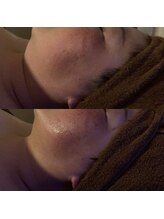 リラチル(relachill)/筋膜リリース（顔）