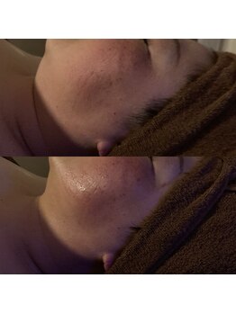 リラチル(relachill)/筋膜リリース（顔）