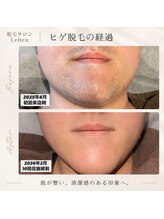 レーベン 戸畑店(Leben)/ヒゲ脱毛変化