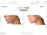 【あご下・頬の集中小顔ケア】ユルーフ小顔リフト《首~頬》100ショット