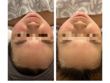 エリー(ERIE)/赤く熱をもつお肌も変化