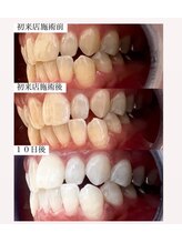 ホワイト 福岡天神店(WHITE)/☆プレミアムホワイトニング☆