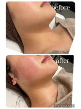 ランソ ビューティー 成田(RUNSO Beauty)/フェイスラインすっきり小顔スパ