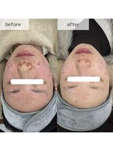 ヴィーナス(Venus)/エステ版ポテンツァ　3回