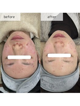 ヴィーナス(Venus)/エステ版ポテンツァ　3回