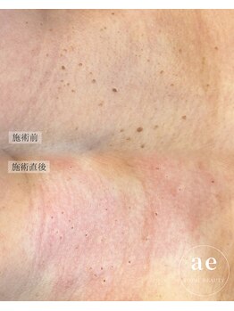 アエ(ae)/スポットクリア