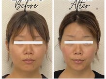 エステサロン クブ(Kubu)の雰囲気（最強小顔セット　4DＶリフトサーマル×3D筋膜ゴルギ）