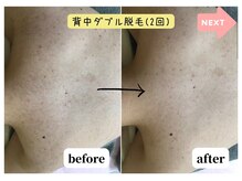 ジョエルワックス 沖縄コザ店(JOELLE WAX)/背中ダブル脱毛☆[2回)