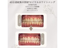 プラスビーセルフ(+b self)/ホワイトニングビフォーアフター