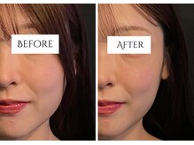 クク 赤坂 天神(99 KUKU)/【むくみ】【ほうれい線】