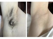 ミナミ/ワキ脱毛５回照射