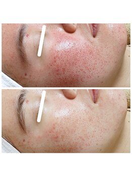 アンティクイーン(Antiqueen)/グレーズソフトピール