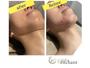 インチャント(enchant)/ニキビケア