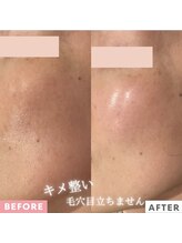 ハリーネ(HARINE)/【2回で効果実感】