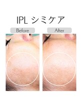 イチキュービー 仙台駅前東口店(19B)/IPL光フェイシャル
