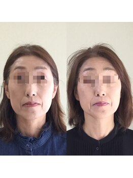 トータルトリートメント優鍼灸院/美容鍼3回の効果