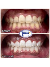 ティースペース 蒲郡店(T-space)/クリスタルWhiteコース