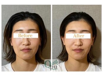 キュープ 北千住店(Qpu)/小顔頭蓋骨矯正.4