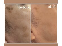 アリィ(Alii)/シミケア/機械とスキンケアのW