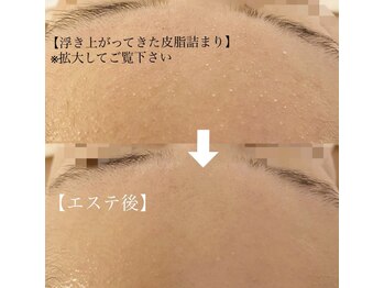 ゴールド 栄店(GOLD)/浮き上がってきた【皮脂詰まり】