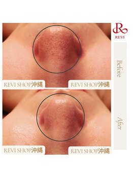 ルヴィショップ 沖縄(REVI SHOP)/毛穴レスも叶う★